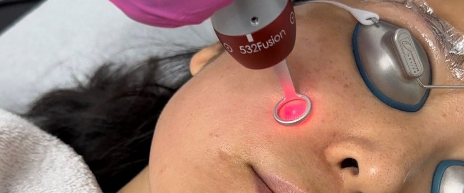A person getting their face laser hair removal