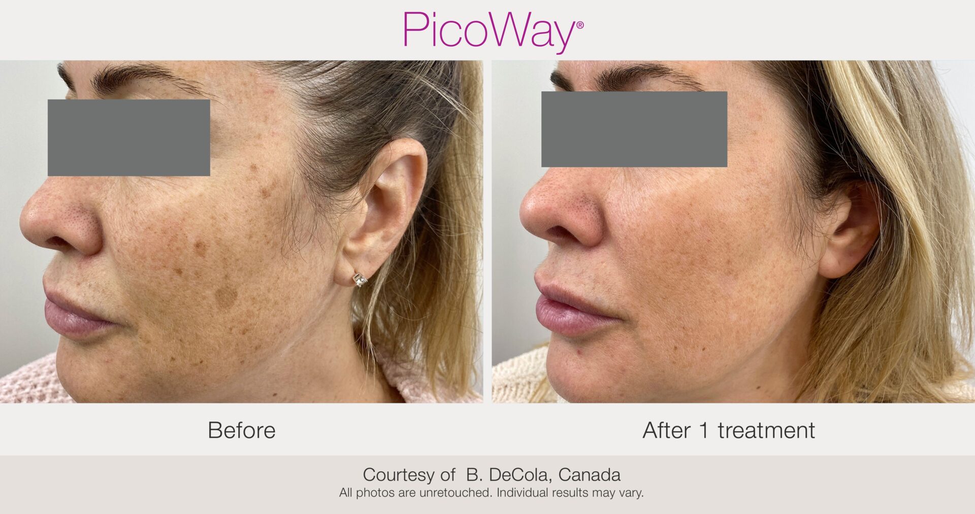 A woman 's face before and after using picoway