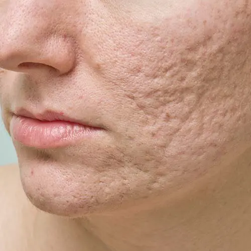 A man with acne scars on his face.